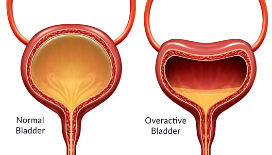 Overactive Bladder & Urinary Incontinence